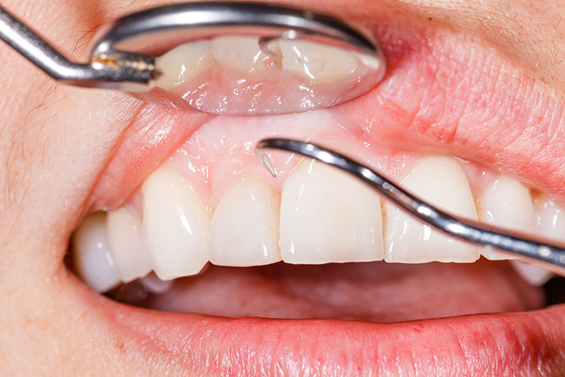 periodontics in se calgary
